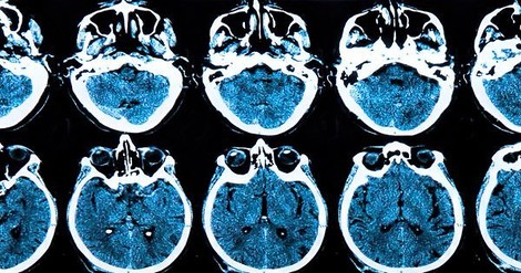 On World Parkinson's Day, A Glimmer Of Hope For The Disease With No Cure
