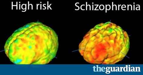 The Brain Is Not A Privileged Organ – Says The Immune System